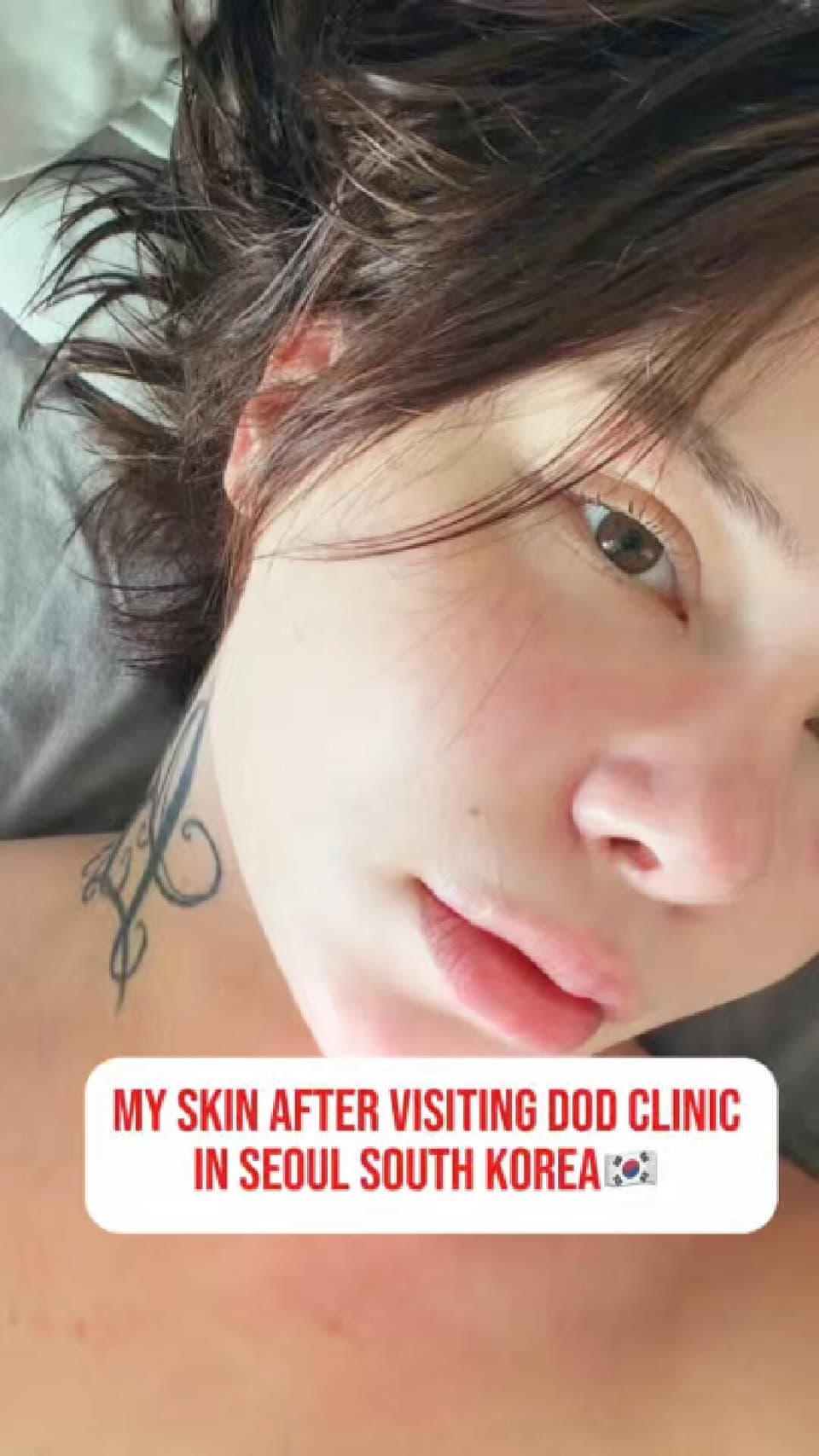 My skin after skin clinic in Seoul