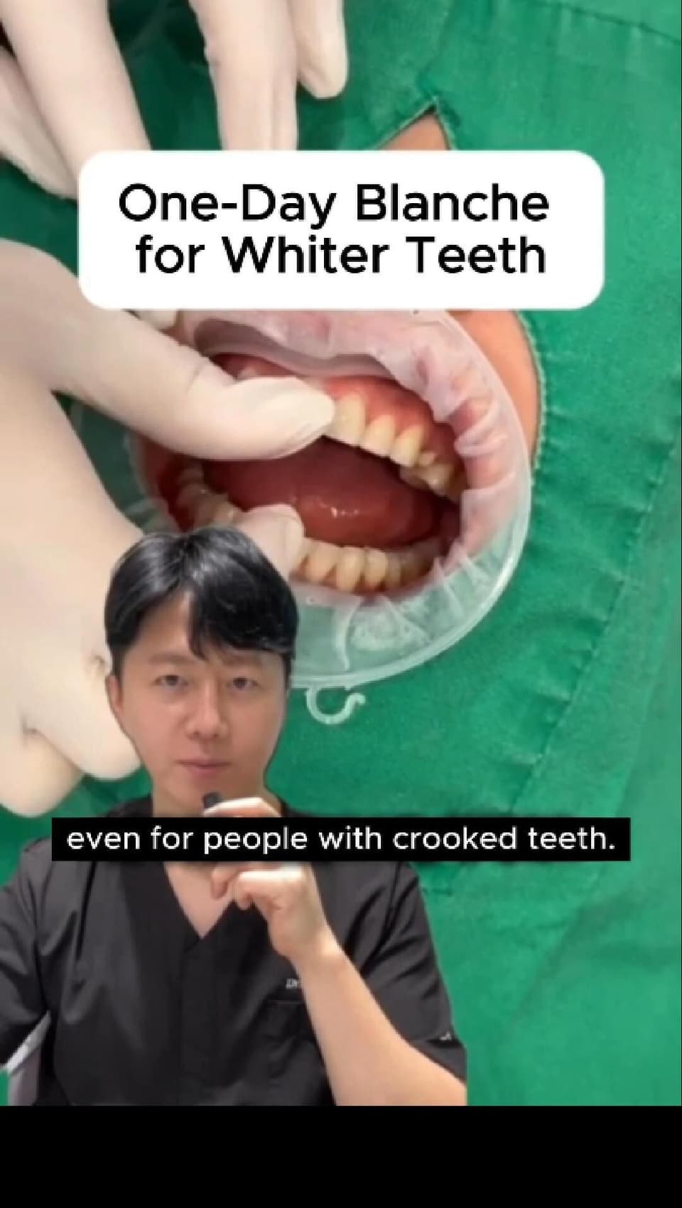One-Day Blanche for Whiter Teeth