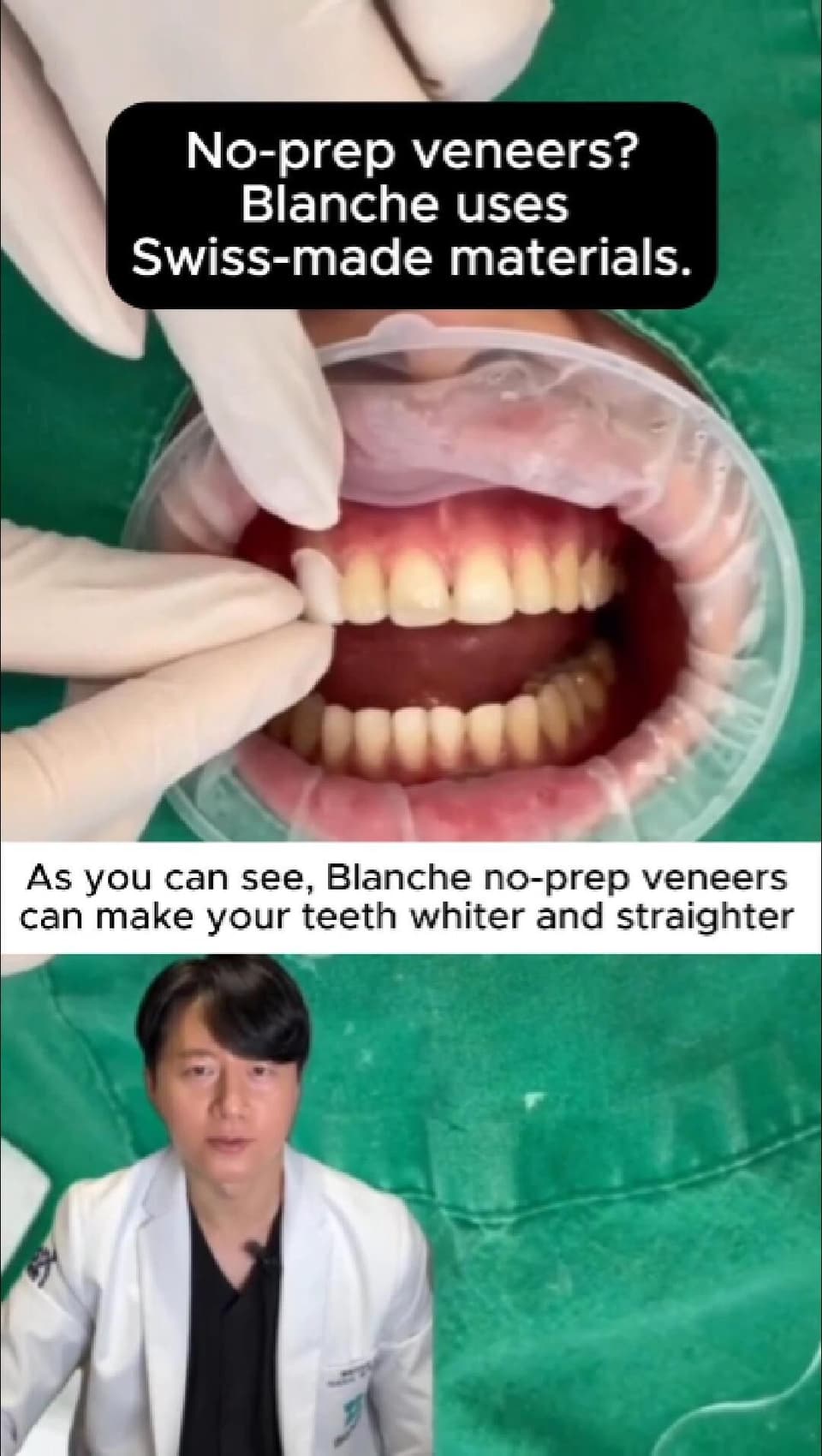 No-prep veneers? Blanche uses swiss-made materials