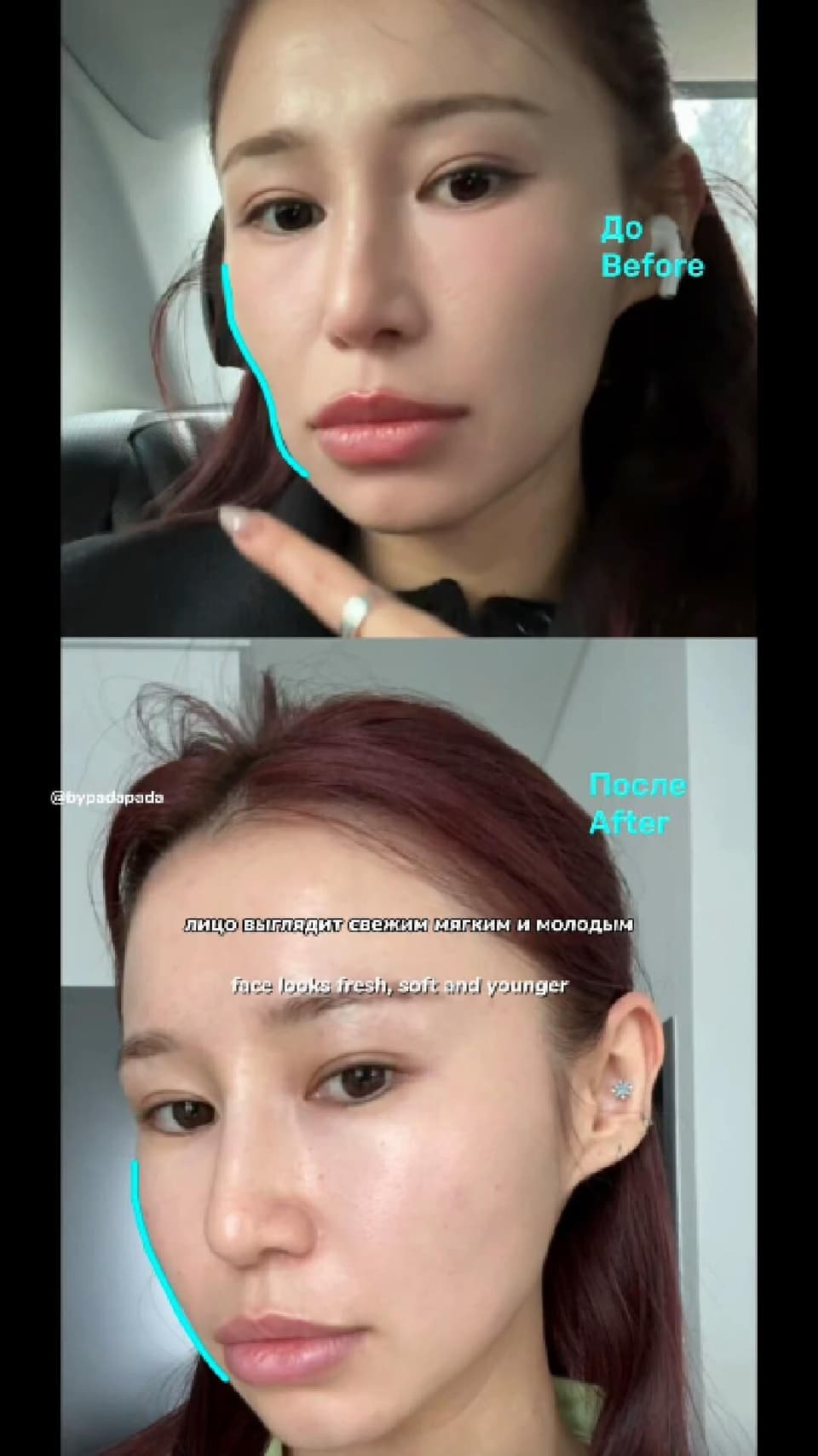 Worried about losing volume in your face?