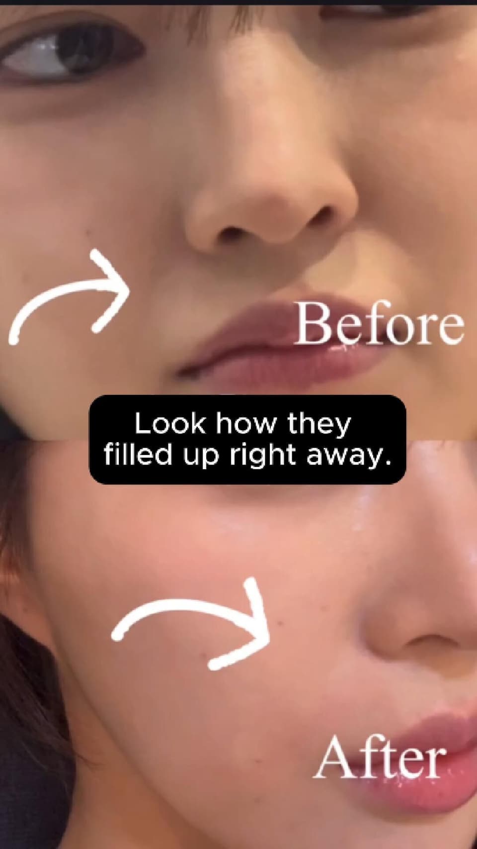 Smile line hack! Get rid of wrinkles fast!
