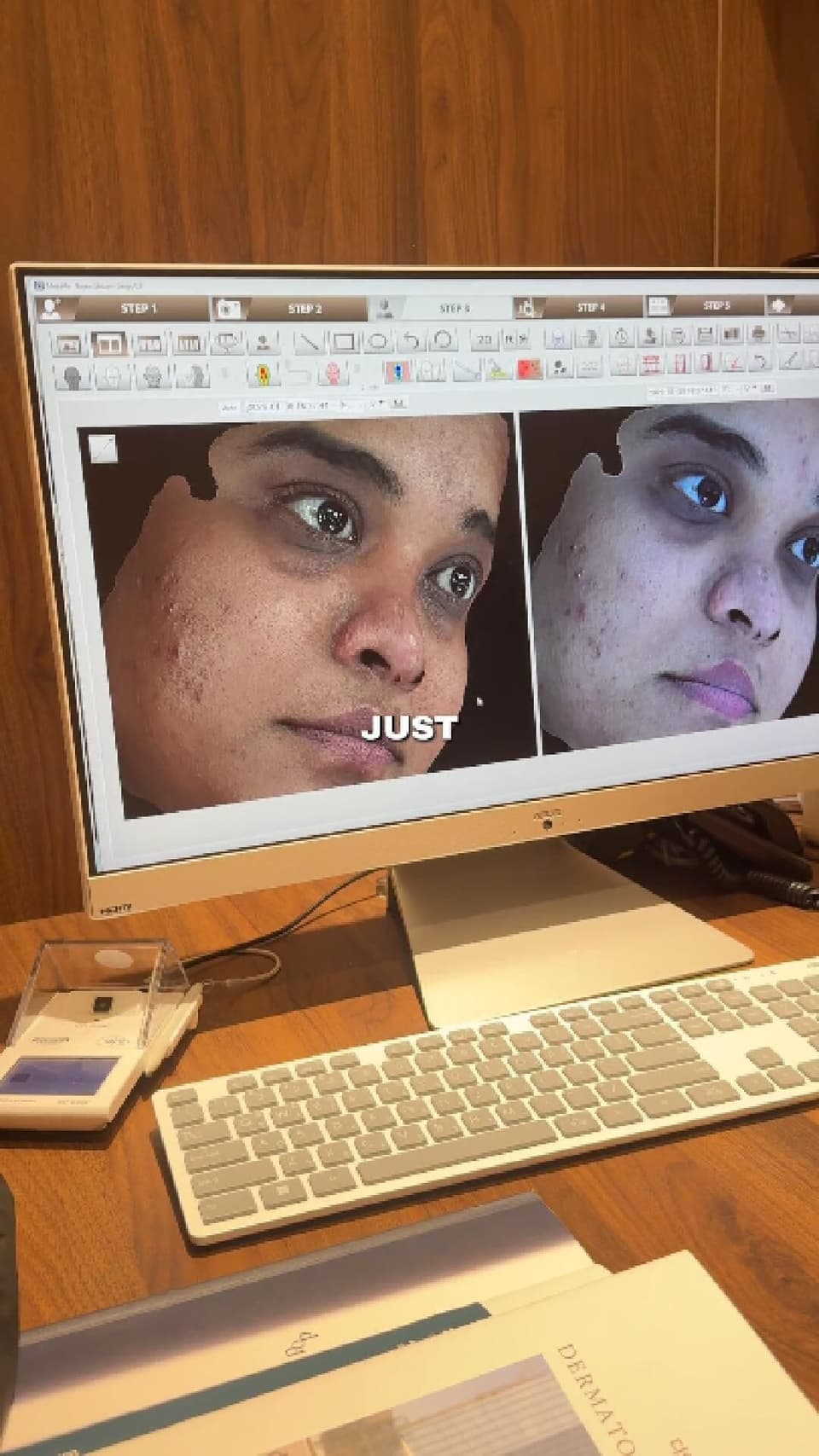 Getting rid of pimples right away!