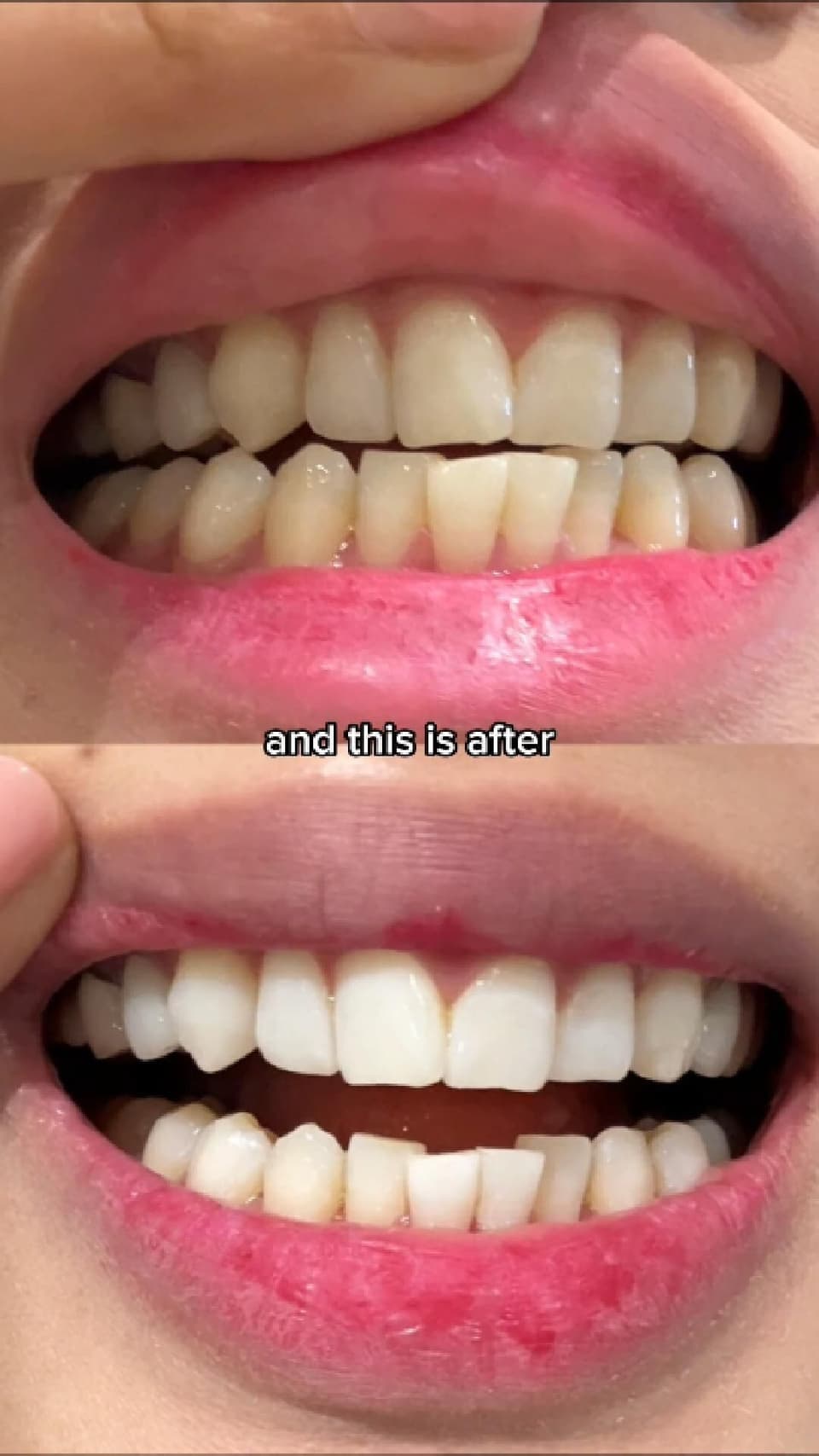 Get your theeth whitened in 2 hours!