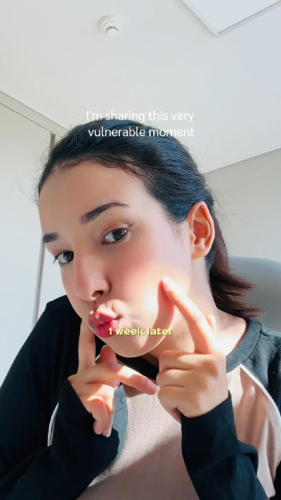 How to get rid of hollow cheeks?