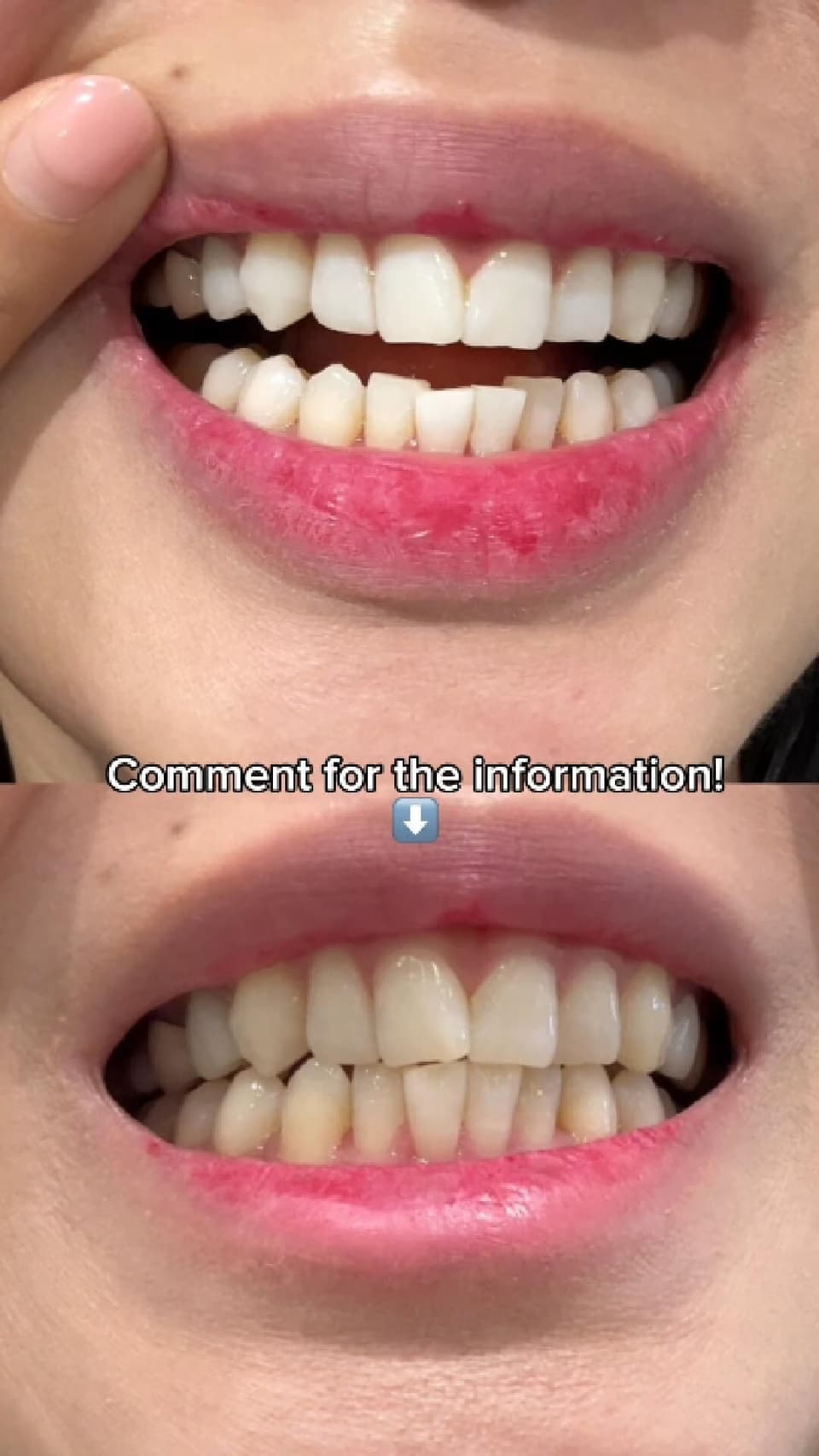 Teeth Whitening Before & After: Surprising Results